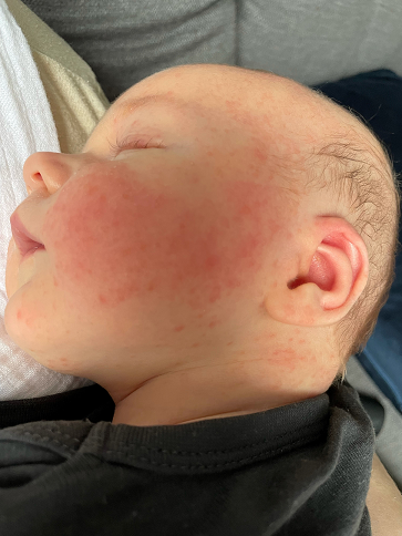 infant acne.png